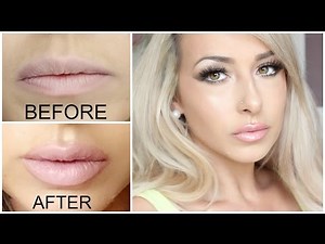 GETTING LIP INJECTIONS!! Juvederm (lip injections) before and after