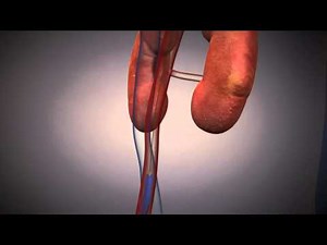 Transcatheter Aortic Valve Implantation (TAVI)- Health Plus Animated