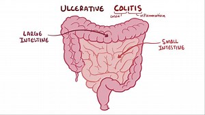 Video: Ulcerative colitis - Video Explanation! | Osmosis | Osmosis