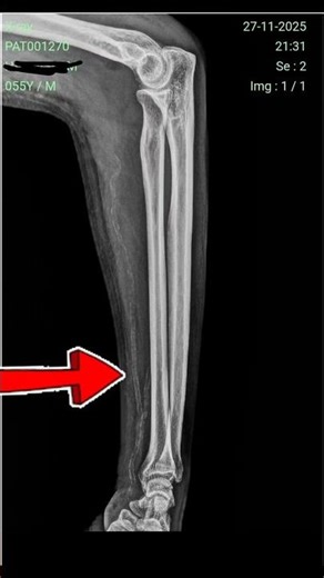 vascular calcification
