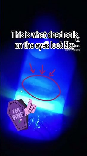 Fluorescein dye shows tiny surface damage on the cornea causing irritation.