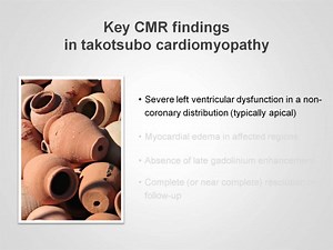 Takotsubo or "broken heart syndrome" is a fascinating disease. It's sometimes hard to differentiate it from myocardial infarction. In this video, you'll learn how to assess Takotsubo with the help of CMR. Find out more: https://bit.ly/3cdXLmJ | Medmastery