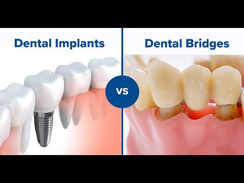 Which is better a dental bridge or implant?