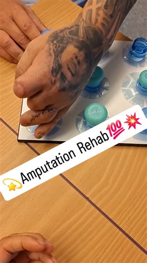 Andrea Moser on Instagram: "Strength has no limits 💪✨ Rehab after finger amputation — rebuilding power, control, and confidence one rep at a time. #handtherapy #ergotherapie #occupationtherapy #handtherapie #occupationaltherapy #handexercise #tendoninjuries #surgeons #physiotherapy #certifiedhandtherapist #amputee #amputationrehabilitation #fingeramputee"