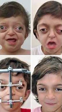 crouzon syndrome #crouzonsyndrome #science #crouzon #disease