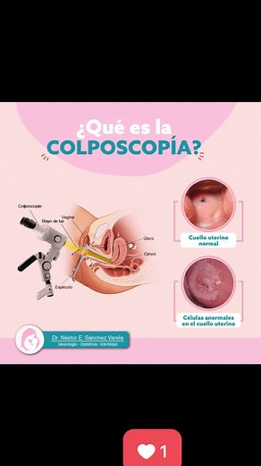 [#Colposcopia] ¿Que es una *COLPOSCOPIA*?: Una *COLPOSCOPIA* es una manera de lograr una vista aumentada del cuello uterino. Es una forma rápida y fácil de detectar cambios celulares en el cuello uterino producidad por el VPH que pueden convertirse en cáncer. La *COLPOSCOPIA* puede usarse para diagnosticar lo siguiente: * *Verrugas genitales* * Infeccion por *VPH* * Inflamación del cuello uterino (cervicitis) * Ulceras. * Polipos Cervicales. * Cambios precancerosos en el tejido del cuello uterin