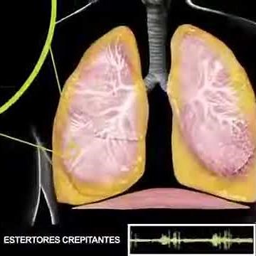 Estertores Crepitantes, Ruídos Adventícios, Ausculta Pulmonar