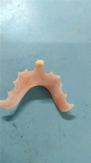 Removable partial denture