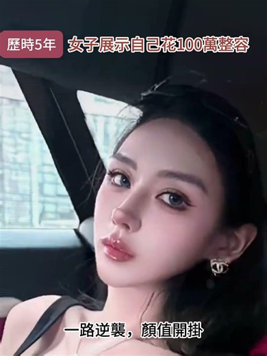 Woman Spends a Fortune on Cosmetic Surgery: 5-Year Transformation Goes Viral