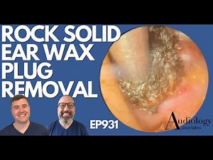 ROCK SOLID EAR WAX PLUG REMOVAL - EP931
