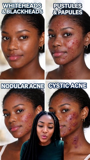 Understanding Different Types of Acne and Their Care