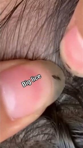 lice infestation #headliceremoval #licecomb #headlice #headlicetreatment #hairlice #haircare #hair