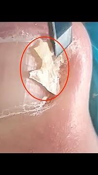 【Daily Pedicure Tutorial】Trimming Out The Massive Ingrown Nails From The Flat Nails