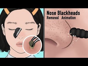 ASMR Satisfying Nose Blackheads Extracted Animation / removal of hair from a mole / Tingles!!