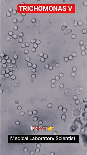 Trichomonas in urine slide examination.#trichomoniasis #microbiology #virology #mycology #parasitolo