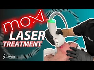 MOXI Laser Treatment Explained | What It Does, Who It’s For, & Real Results