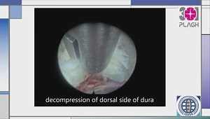 Using a Percutaneous Spinal Endoscopy Unilateral Posterior Approach to Perform Bilateral Decompression for Patients with Lumbar Lateral Recess Stenosis: Focus on Clinical Results and Technical Notes