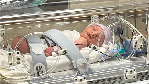 Doctors use breast pump to help baby born with dent in skull