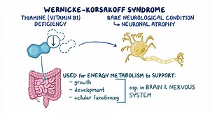 Video: Wernicke-Korsakoff syndrome: Year of the Zebra - Video Explanation! | Osmosis | Osmosis