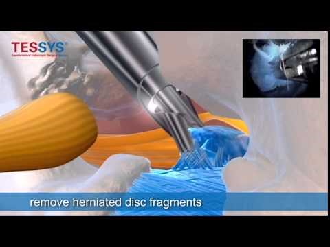 Dr. Gabriele Jasper Walks Us Through An Endoscopic Discectomy Presented by Joimax