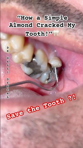 🦷 “How a Simple Almond Cracked My Tooth!”