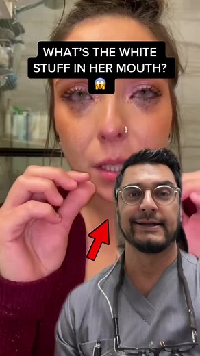 Understanding and Treating White Stringy Stuff in Mouth