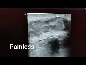 Sebaceous cyst ultrasound and color Doppler video