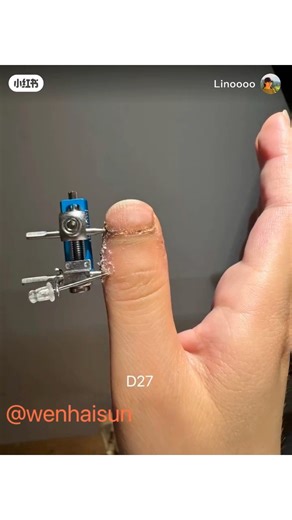 Thumb Transformation Process (After Type D Brachydactyly Lengthening Surgery) #stubbythumbs #brachydactyly #toethumbs #brachydactylyTypeD | Wenhai Sun