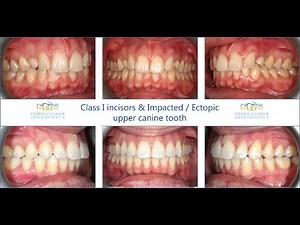 Class I occlusion & ectopic, impacted upper canine teeth - Surgical exposure & ceramic fixed braces