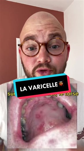 Reconnaître la varicelle en moins de deux minutes