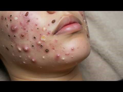 Loan Nguyen Acne Treatment 37ss