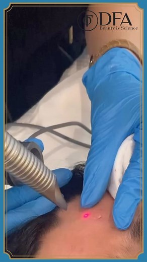 Ablative Erbium YAG Laser is a one-time procedure for any type of scars including acne, chicken pox etc. Scars following acne and injuries are common and an important cause of concern to patients. They can be treated with various modalities including lasers. @euromedclinic Book your appointment at DFA now. Call 📞 92518733552 📞 92518733553 Or log on to 🌐 www.drfazeela.com 📍House 2, street 44, F8/1, Islamabad Dubai 📍Villa 611, Jumeirah Beach Road, – Dubai – United Arab Emirates 📞 Landline: 0