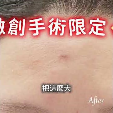 粉瘤脂肪瘤大不同!