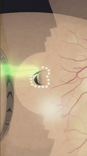 Laser photocoagulation around retinal tear #laser #eyes #eyecare #eyesurgery
