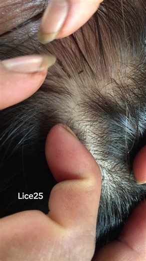 Effective Lice Removal: Shocking Results Revealed