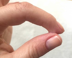 How To Remove Feviquick From Hands, Skin And Hard Surfaces?