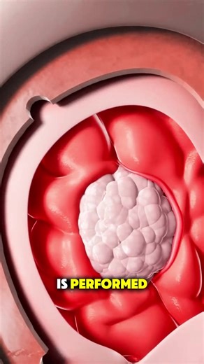 Understanding Brain Tumor Surgery: What to Expect