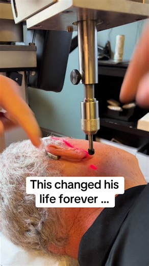 After suffering with vertigo episodes 3x per week, for 3 years (Ménière’s disease)……he’s found us in Feb 2024 and has had 3 treatments total, and has been vertigo free for over a year. If you’re dealing with dizziness or vertigo comment below for info on care #menieresdisease #vertigo #dizziness