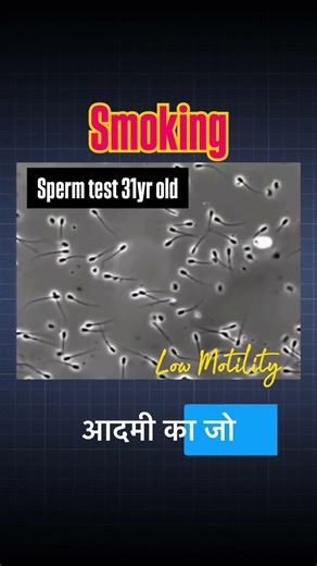 Microscopic view of sperm test #sperm #maleinfertility #infertility #motility #pregnancy