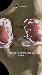 Você acha que operar o LCA resolve o problema do joelho pra sempre?