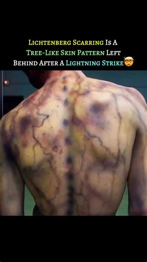 Medical | Science | Facts on Instagram: "Lichtenberg scarring is a rare and striking skin pattern that can appear when a person is struck by lightning. Named after German physicist Georg Christoph Lichtenberg, these marks resemble branching trees or fractals and are caused by the intense electrical discharge spreading over the skin. The pattern forms as blood vessels near the surface rupture due to the electrical shock, leaving behind reddish, fern-like traces. While they often fade within hours