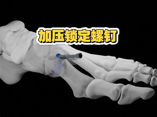 IntraLock:足踝矫正锁定加压固定螺钉