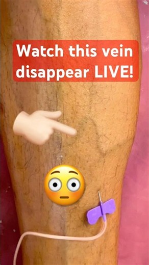 Watch Varicose Veins Disappear Instantly! 😲 Live Foam Sclerotherapy Result | No Surgery | Nashik