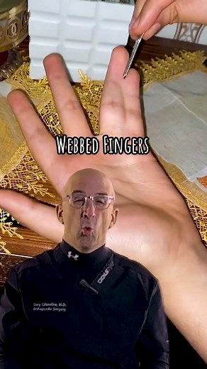 Webbed Fingers & Toes occur ~1:3000 newborns #syndactyly #webbedfingers #congenitalhand #webbedhand