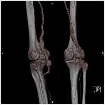 Vascular: Popliteal Aneurysms: Multiple different rendering techniques(4 of 4)
