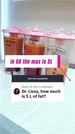 State of GA - fat removal for liposuction is legally limited to 5 liters per procedure.