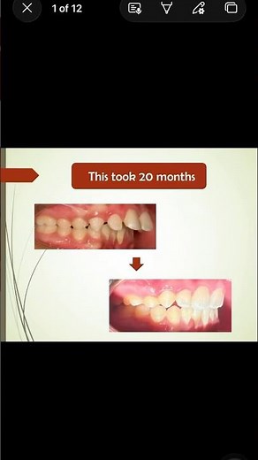 How to correct massive Overjet #bracesjourney #dentalhealth #dentalclinic