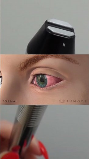 Advanced Dry Eye Care | IPL & RF Technology at Dr. Farid Optometry