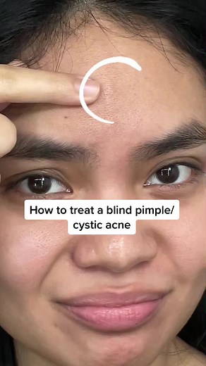 How to Treat a Blind Pimple/Cystic Acne