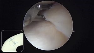 All-inside, all-suture radial tear repair